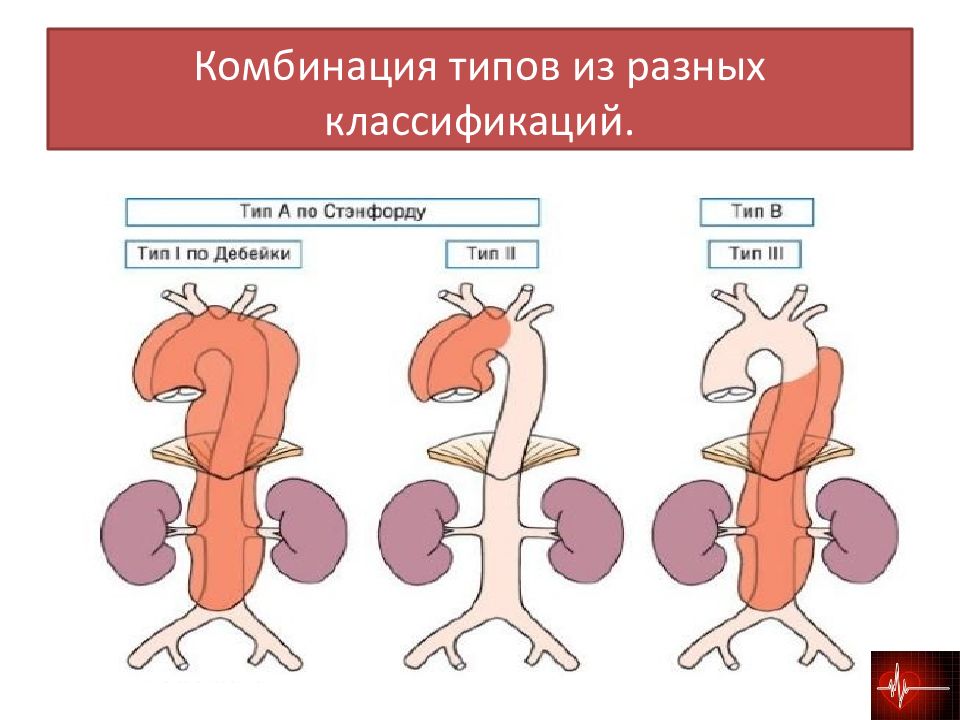 Типы расслоения аорты. Расслоение аорты микропрепарат. Классификация расслоения аорты по Стэнфорду. Коарктация аорты классификация.