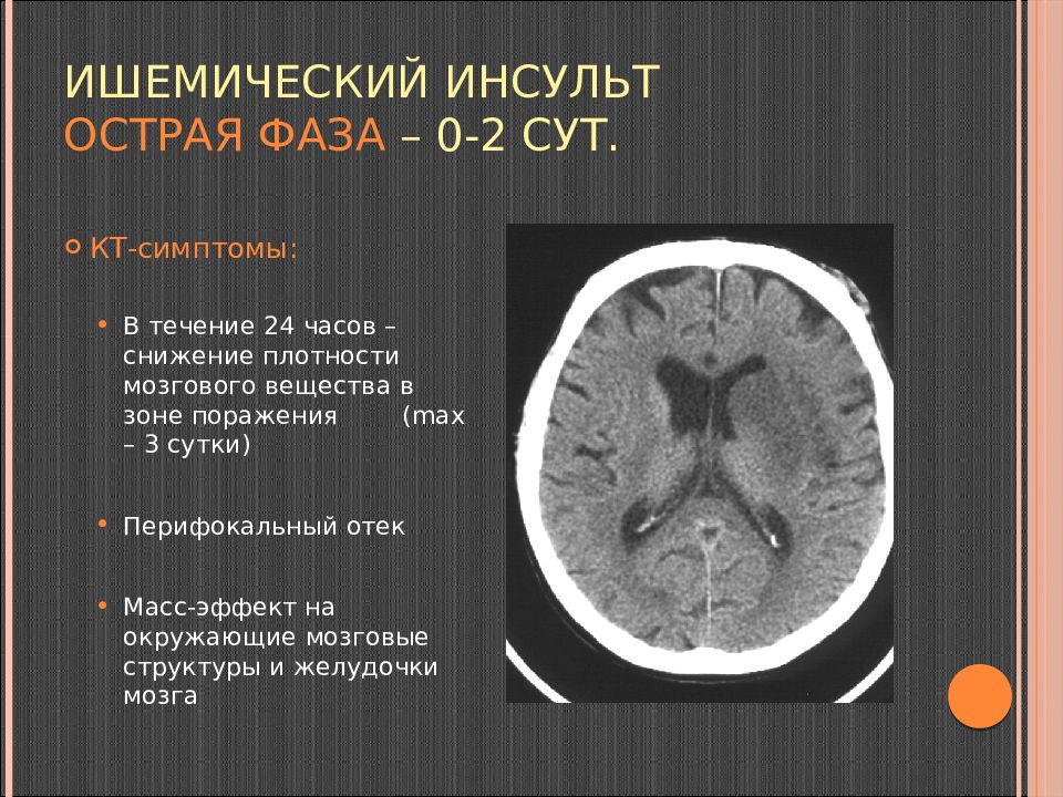 Ишемические изменения головного мозга. Ишемический инсульт симптомы на кт. Плотность ишемического инсульта на кт. Ишемический инсульт на кт головного мозга. Острый ишемический инсульт кт картина.