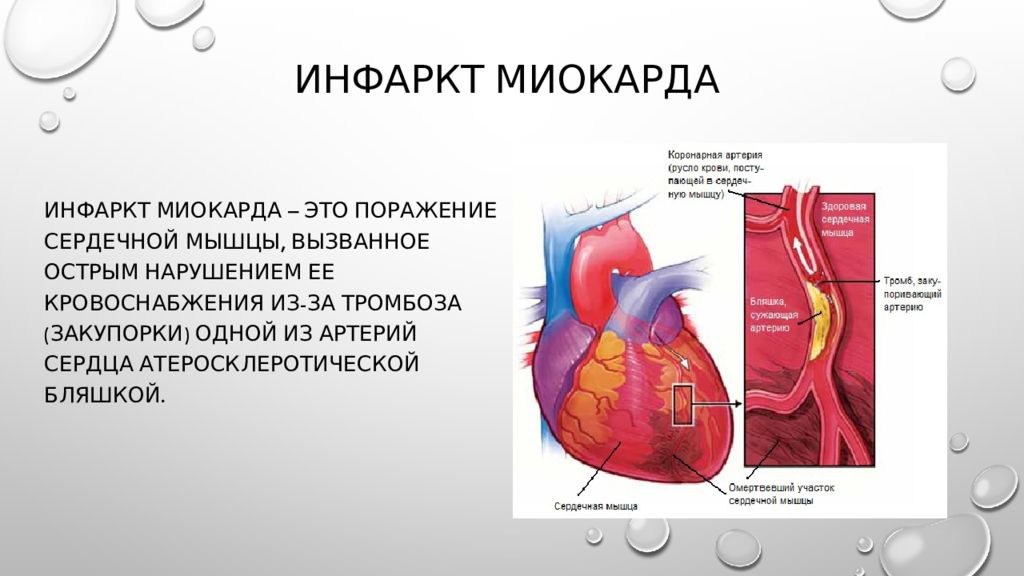 Инфаркт миокарда картинки для презентации