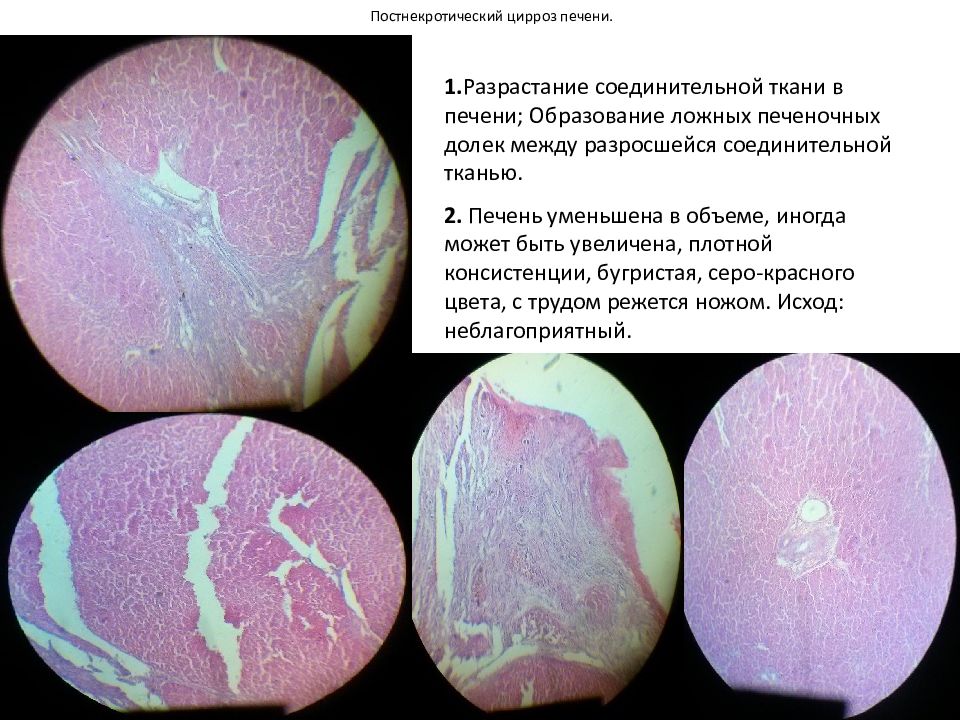 Селезенка при циррозе печени. Постнекротический цирроз. Постнекротический цирроз печени. Постнекротический цирроз печени микропрепарат. Исход постнекротического цирроза печени.