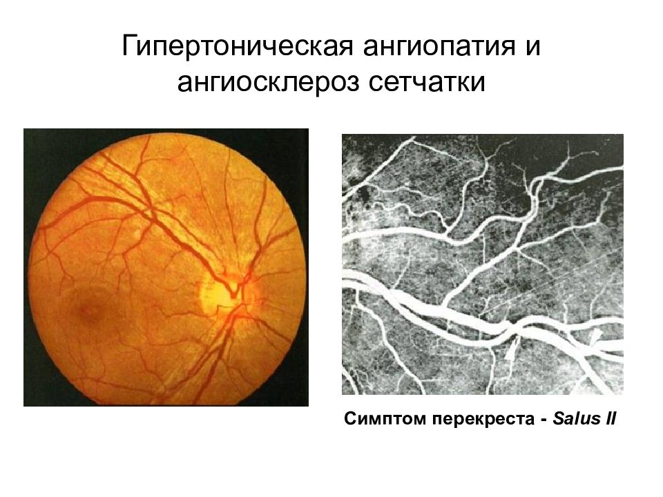 Ангиопатия сетчатки мкб 10. Гипертоническая ретинопатия глазное дно. Гипертоническая ангиоретинопатия сетчатки. Клиника гипертонической ангиопатии сетчатки. Исследование сосудов глазного дна при гипертонической болезни.