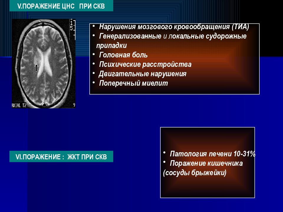 Системная красная волчанка у детей презентация