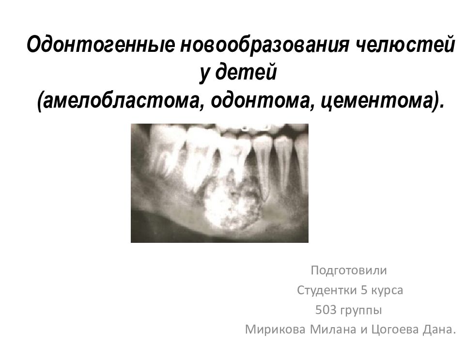 Одонтогенные новообразования челюстей у детей ( амелобластома, одонтома, цементома ).