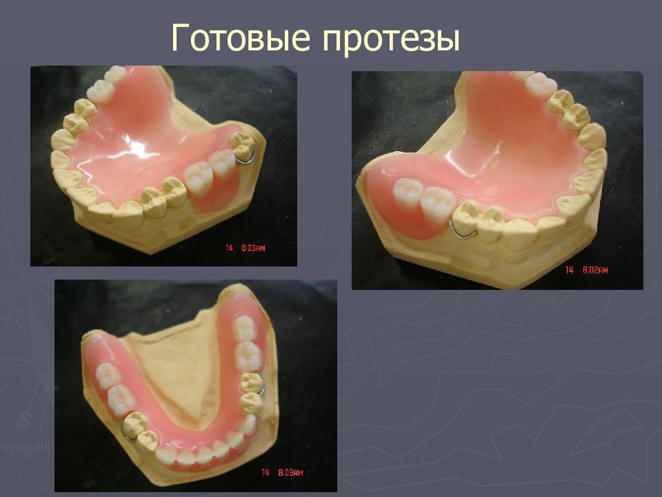 Фиксация шарнира при изготовлении протеза по гаврилову производится