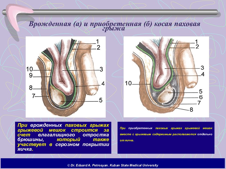 Паховая грыжа рисунок