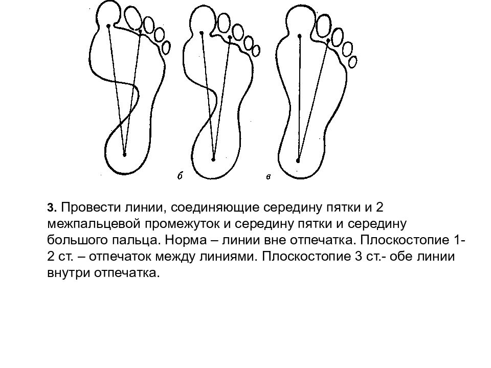 Плоскостопие лфк презентация