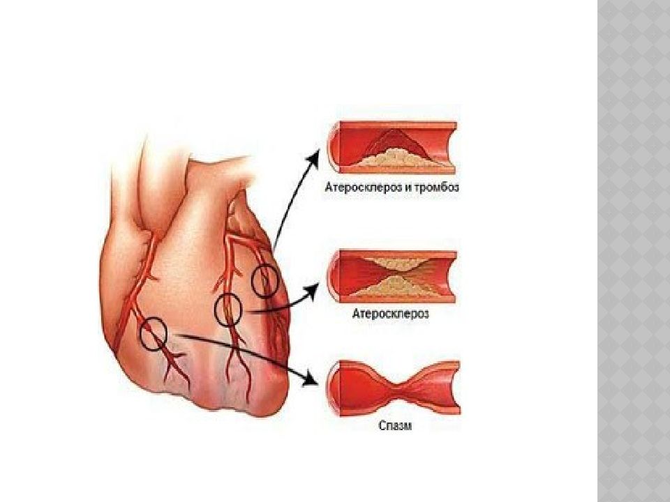 Ишемия это. Ишемическая болезнь сердца схема. Атеросклероз ИБС стенокардия. Этиология ИБС стенокардии. Ишемическая болезнь сердца, стенокардия. Этиология.