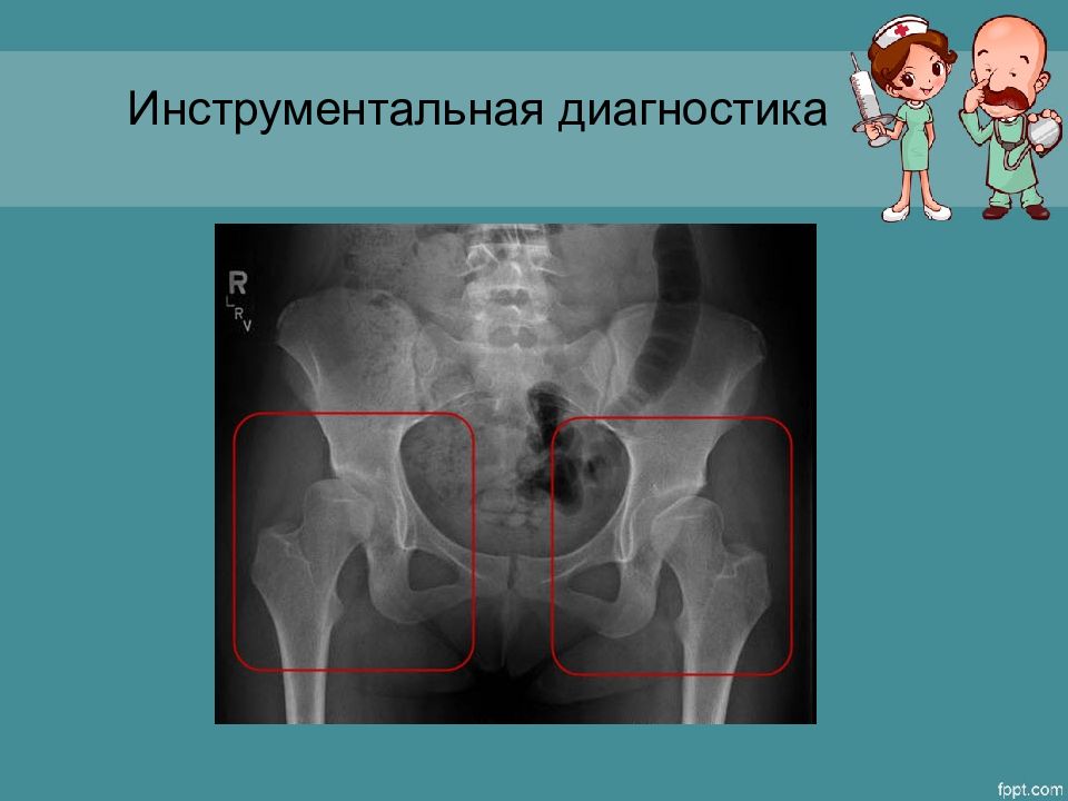 Презентация дисплазия тазобедренных суставов