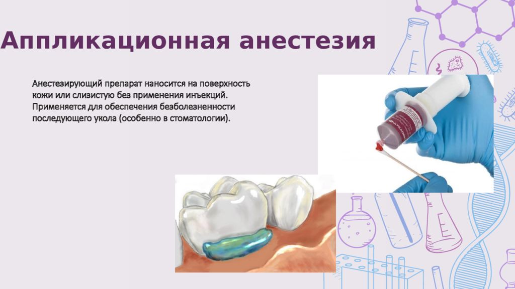 Презентация аппликационная анестезия