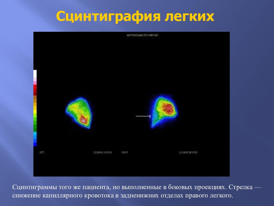 Сцинтиграмма является изображением