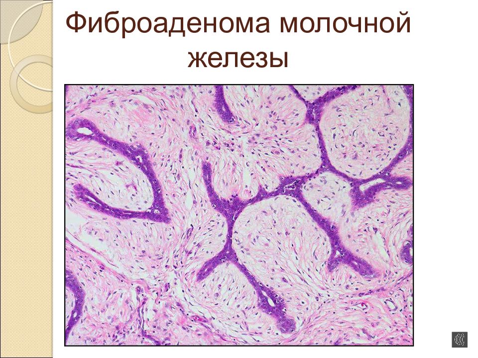 Эпителиальные опухоли. Фиброаденома молочной железы гистология. Филлоидная фиброаденома молочной железы гистология. Листовидная фиброаденома гистология. Филлоидная опухоль гистология.