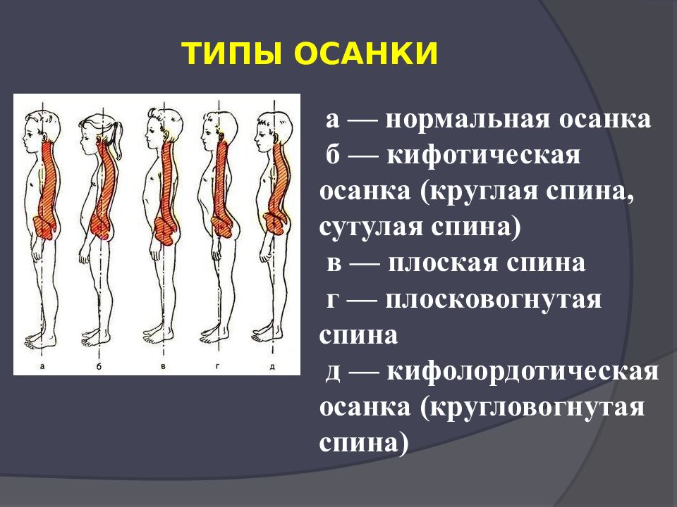 Какие виды осанки. Кифолордотическая осанка. Мышцы осанки. Типы осанки. Плосковогнутая спина.