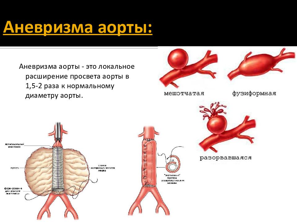 Аневризма брюшной