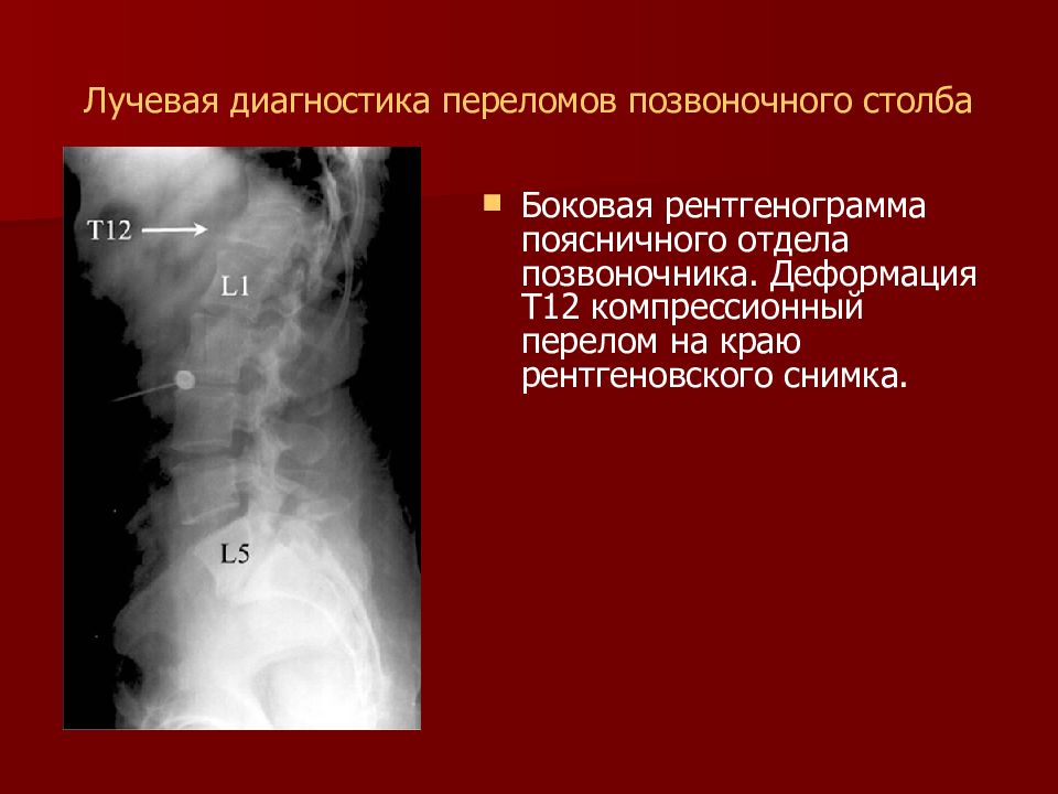 Лучевая диагностика позвоночник презентация