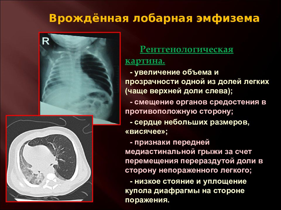 Врожденная лобарная эмфизема клиника рентгенологическая картина принципы лечения