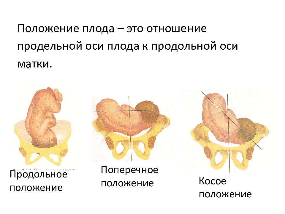 Косое и поперечное положение плода презентация