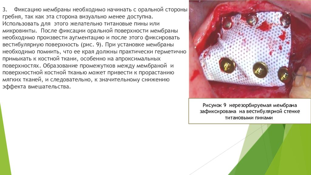 Использованная мембрана. Мембрана при имплантации зубов. Методика направленной тканевой регенерации. Методы регенерации мембран. Фиксация мембраны пинами.