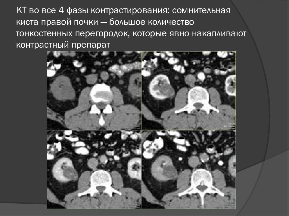 менингиома селлярной области мрт. портальная фаза контрастирования при кт. киста накапливающая контраст. опухоль поджелудочной железы на кт. постинфарктные кисты мозга.