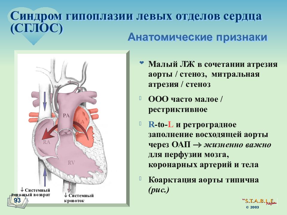 Гипоплазия левой. СГЛС врожденный порок сердца. Синдром гипоплазии левого сердца. Синдром гипоплазии левого желудочка. Синдром гипоплазии левых отделов сердца гемодинамика.