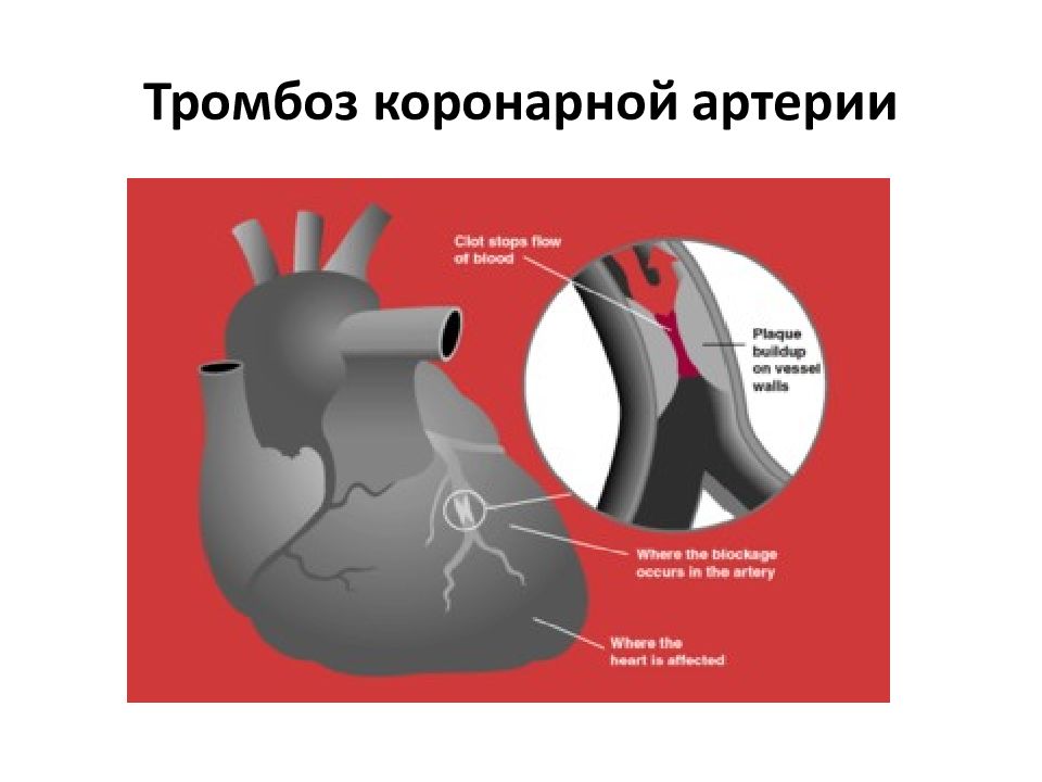 Сердечный тромбоз. Тромбоз коронарной артерии. Тромб в коронарной артерии. Образование тромба в коронарной артерии. Тромбоз правой коронарной артерии.
