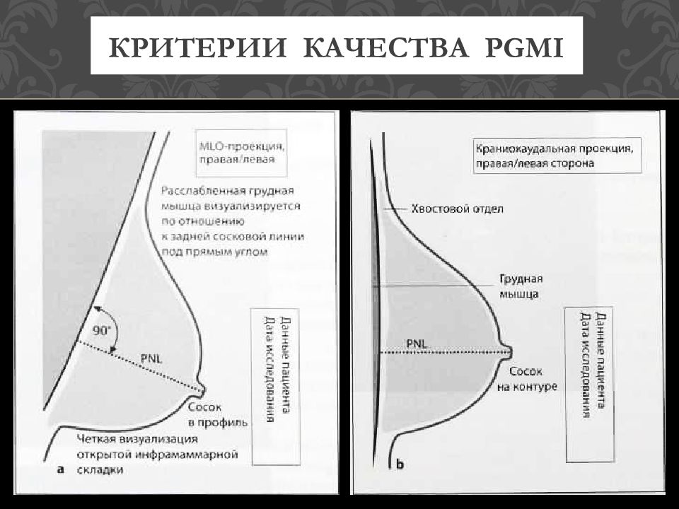 Квадранты молочной железы схема на маммограмме