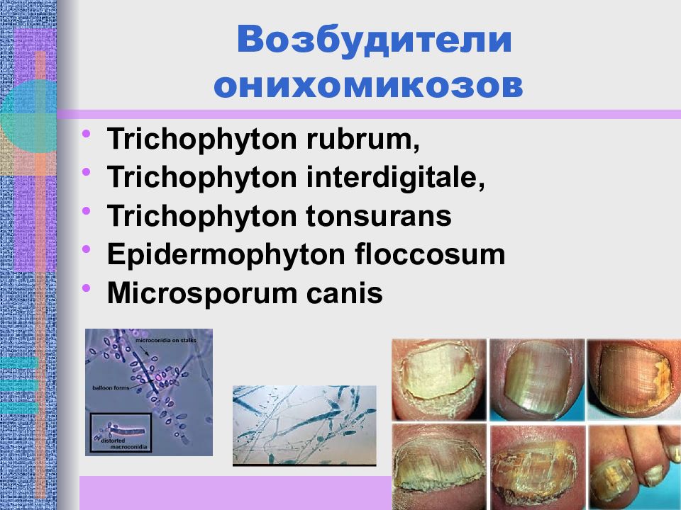 Онихомикоз схема. Возбудители онихомикоза. Онихомикоз возбудитель. Презентация грибковые инфекции. Онихомикоз презентация.