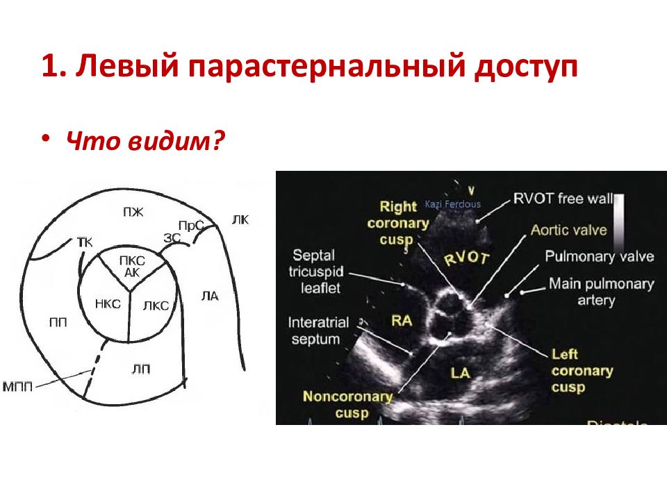 Узи сердца схема