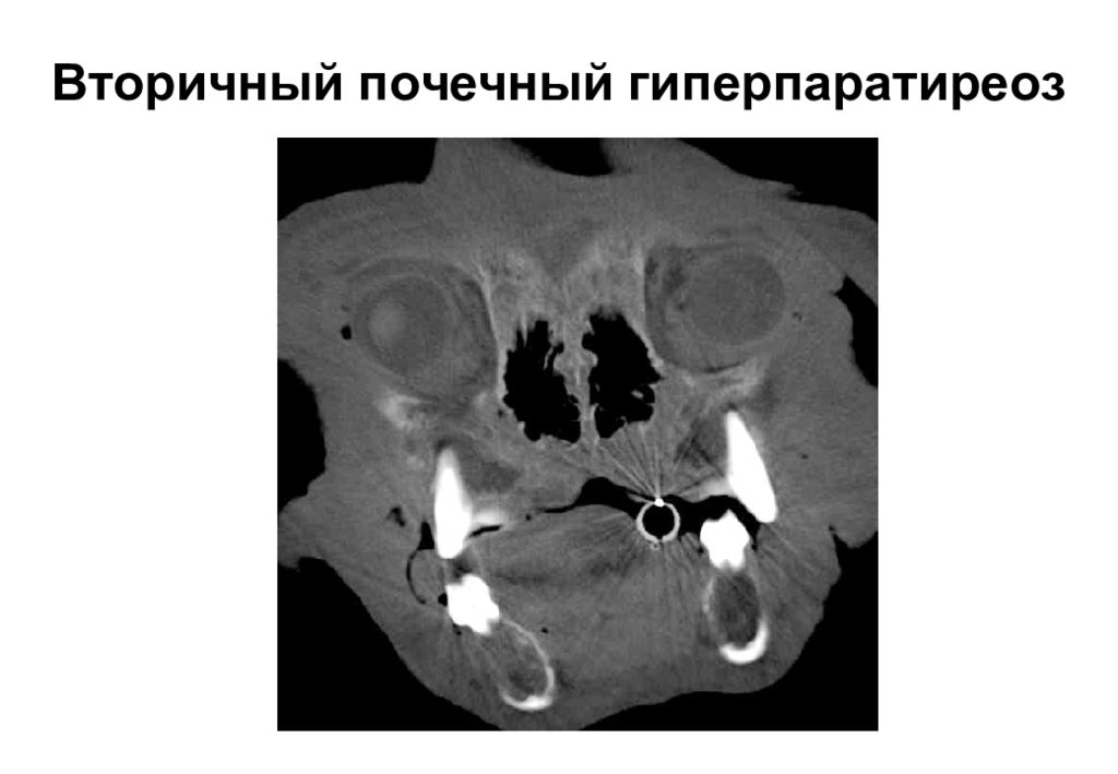 Фото вторичный гиперпаратиреоз