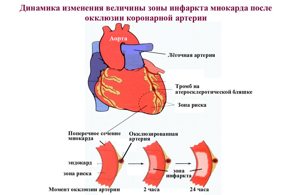 Коронарная недостаточность презентация