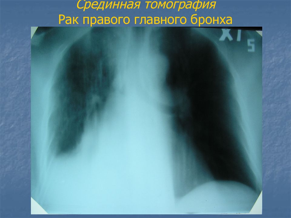 Рак правого. Опухоль главного правого бронха. Линейная томография трахеи. Линейная рентгеновская томография опухоль бронха. Патогенез опухоли главного бронха.