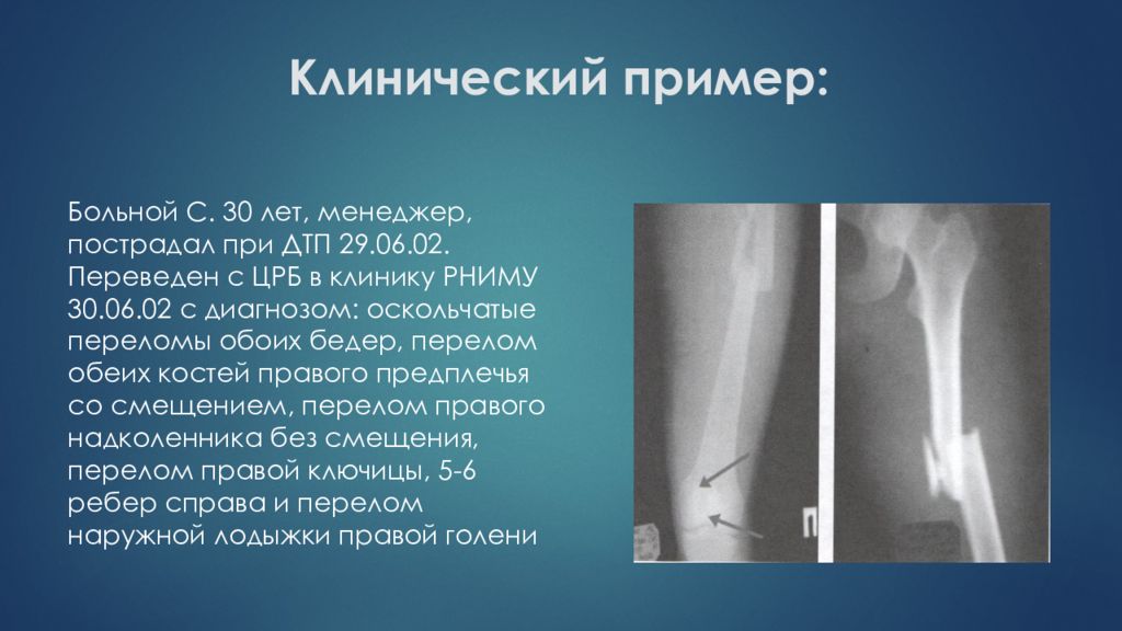 Перелом бедренной кости клинические рекомендации тесты нмо. Оскольчатый перелом бедренной кости. Жировая эмболия при переломах бедренной кости. Эмболия при переломе бедра. Синдром жировой эмболии.