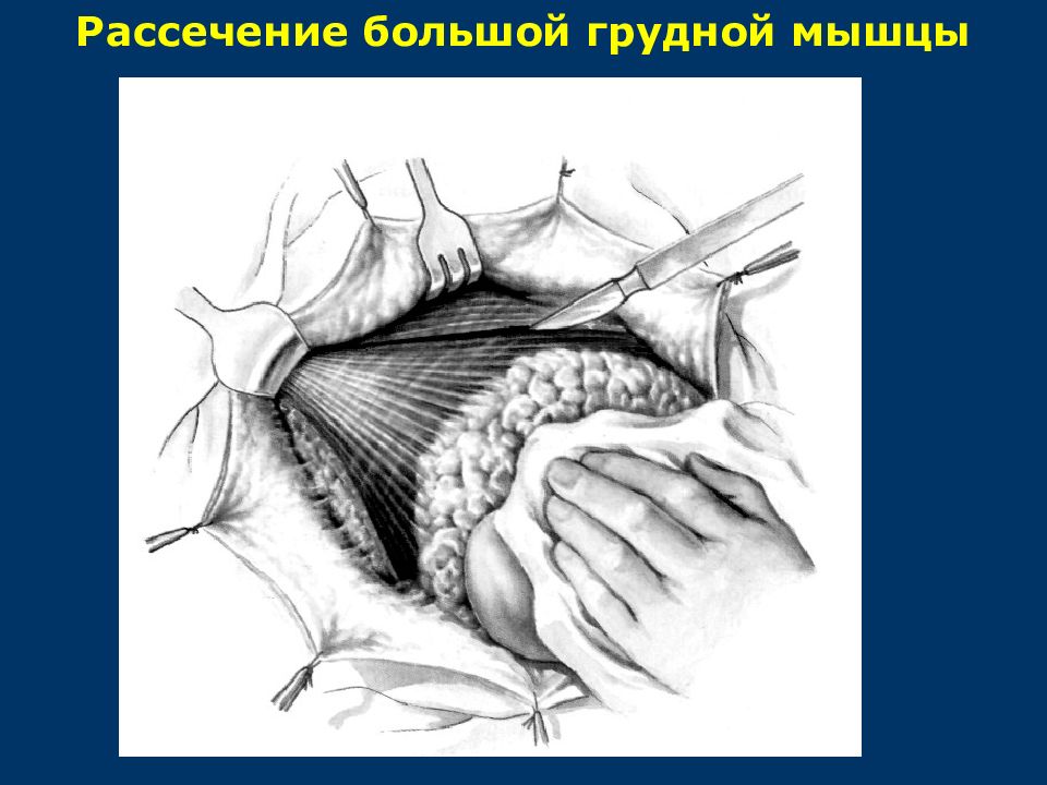 Операция молочной. Операция молочной железы. Гнойный мастит операция.