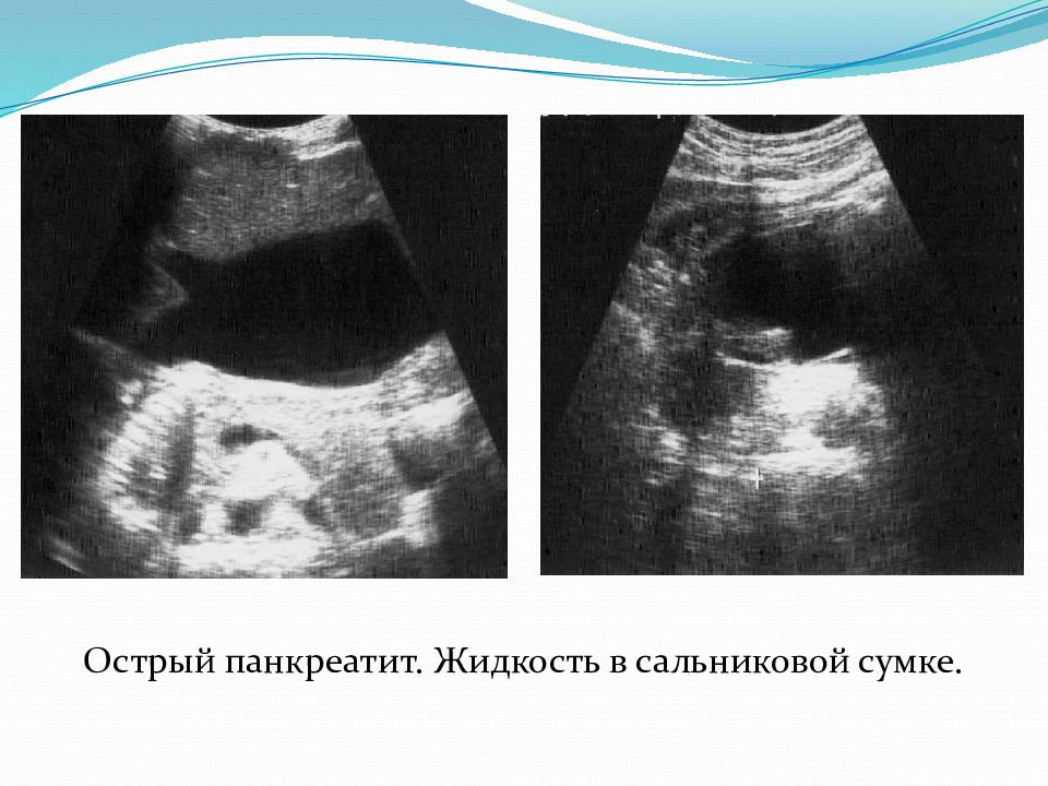 Картина узи при панкреатите