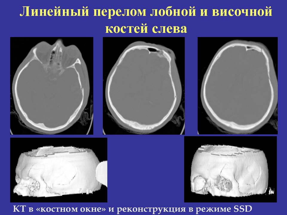 Линейная трещина. Перелом лобной кости кт. Перелом височной кости рентген. Перелом теменной кости на кт. Линейный перелом лобной кости.