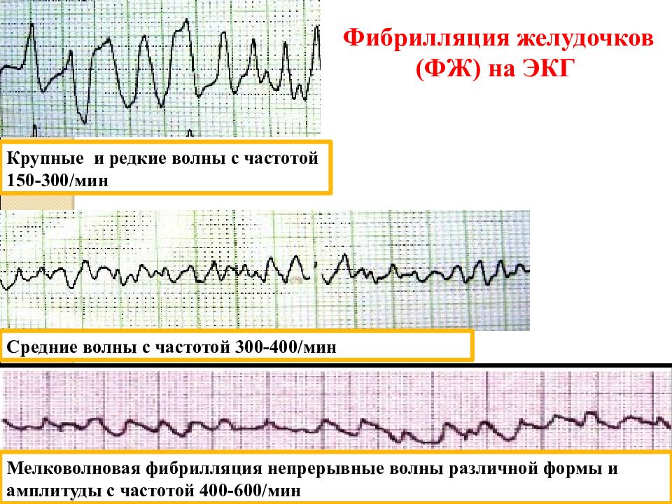 Фибрилляция желудочков картинки