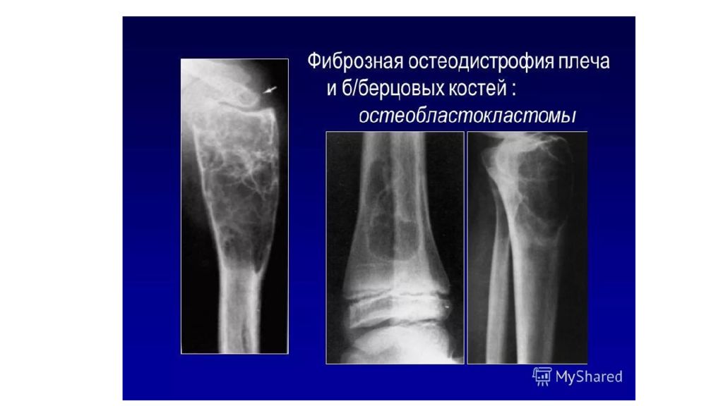 Фиброзная дисплазия. Фиброзная дисплазия большеберцовой и малоберцовой кости. Фиброзная остеодистрофия рентген. Фиброзная дисплазия малоберцовой кости кт. Фиброзная дисплазия большеберцовой кости кт.