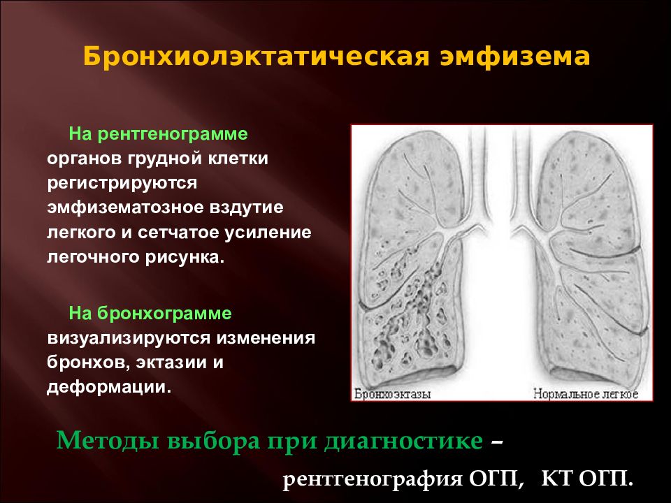 Что такое эмфизема легких. Бронхиолоэктатическая эмфизема. Бронхиолоэктатическая эмфизема Лешке. Бронхоэктатическая болезнь и эмфизема. Бронхоэктатическая эмфизема Лешке.