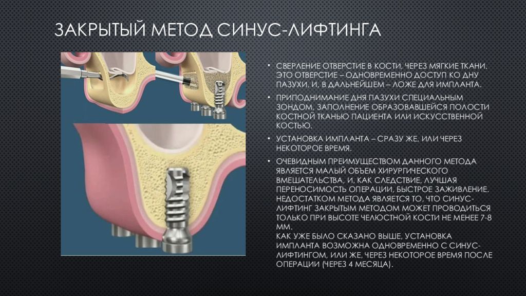 Презентация закрытый синус лифтинг