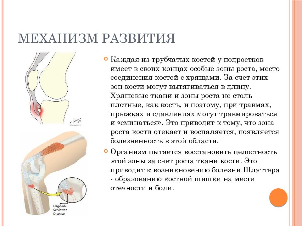 Картина болезни осгуд шляттера