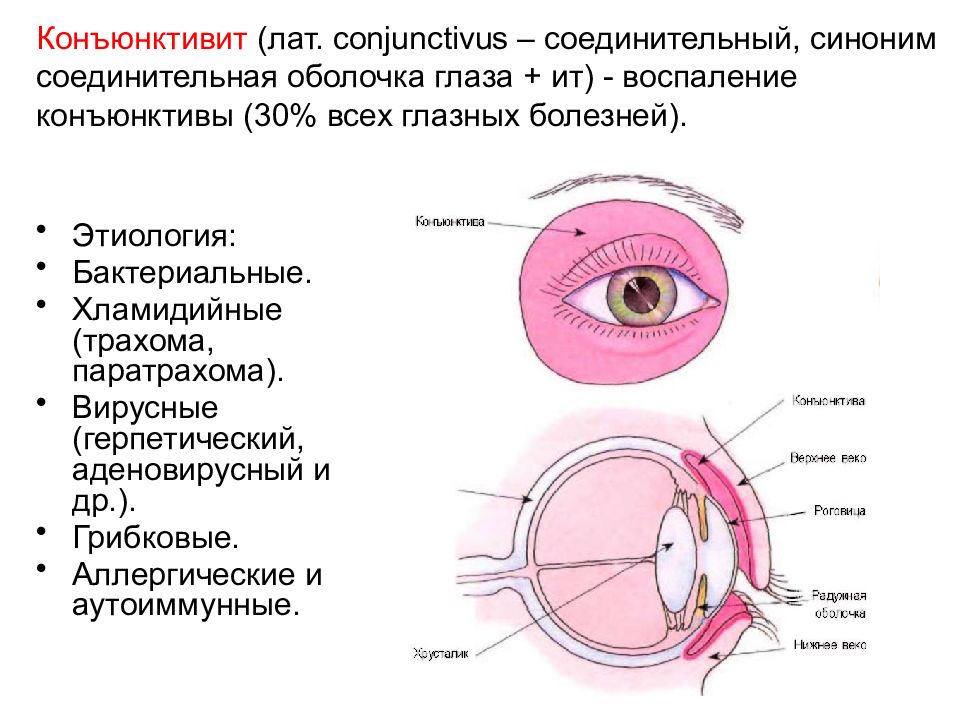 Вирусное заболевание глаз. Аденовирусный конъюнктивит пленки. Хламидийное поражение глаз. Конъюнктива воспаление.