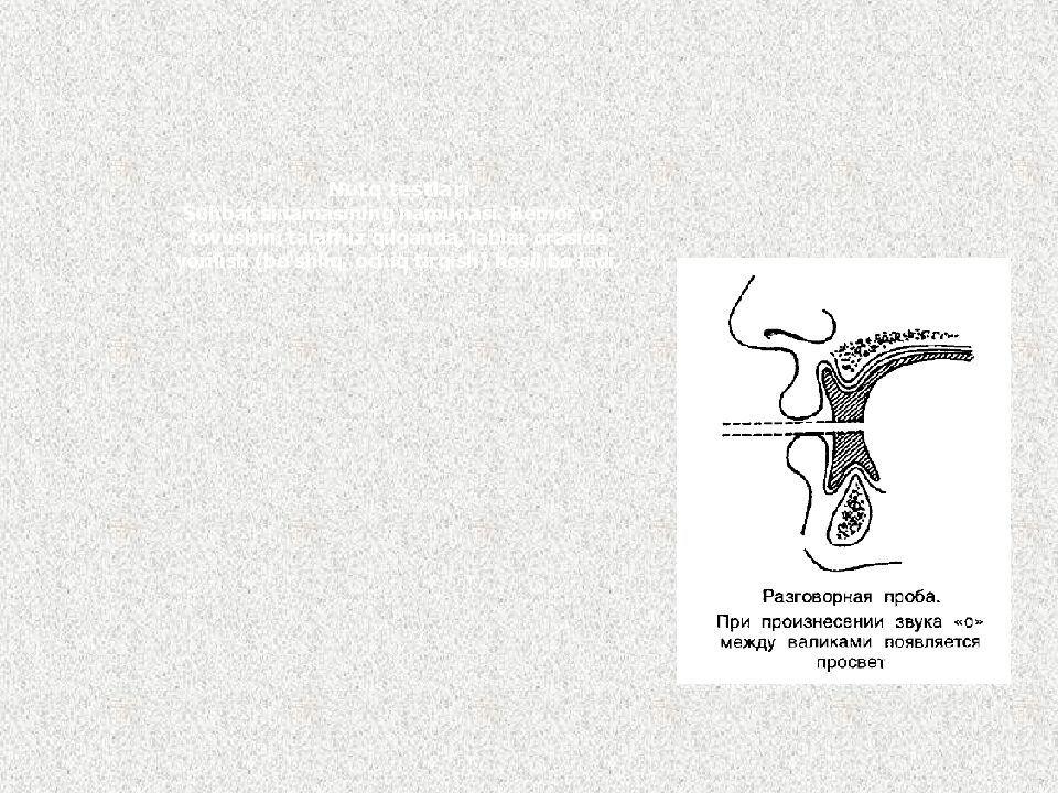 Nutq testlari Suhbat sinamasining namunasi. Bemor “o” tovushini talaffuz qilganda, lablar orasida yorilish ( bo‘shliq, ochiq tirqish ) hosil bo‘ladi.