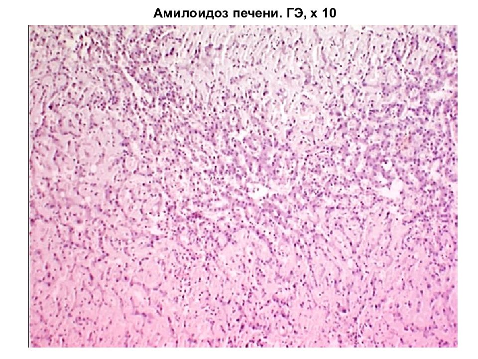 Амилоидоз печени презентация
