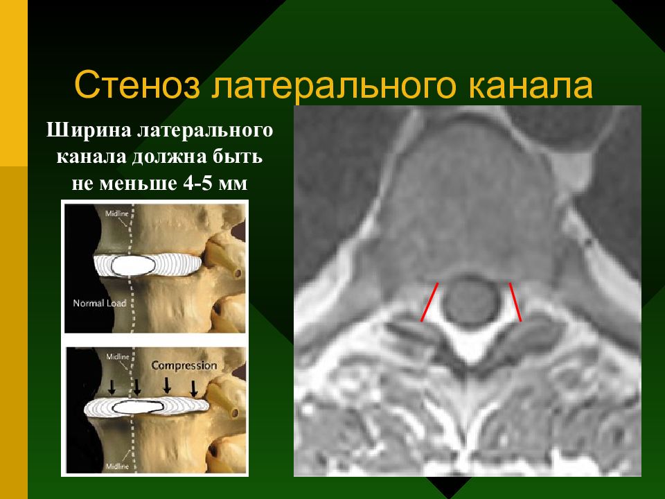 Стеноз позвоночного канала. Сужение латерального кармана позвоночного канала. Латеральный карман позвоночника. Стеноз позвоночного канала на кт. Стеноз канала.