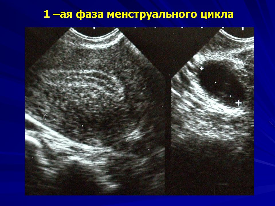 Миома задней стенки на узи