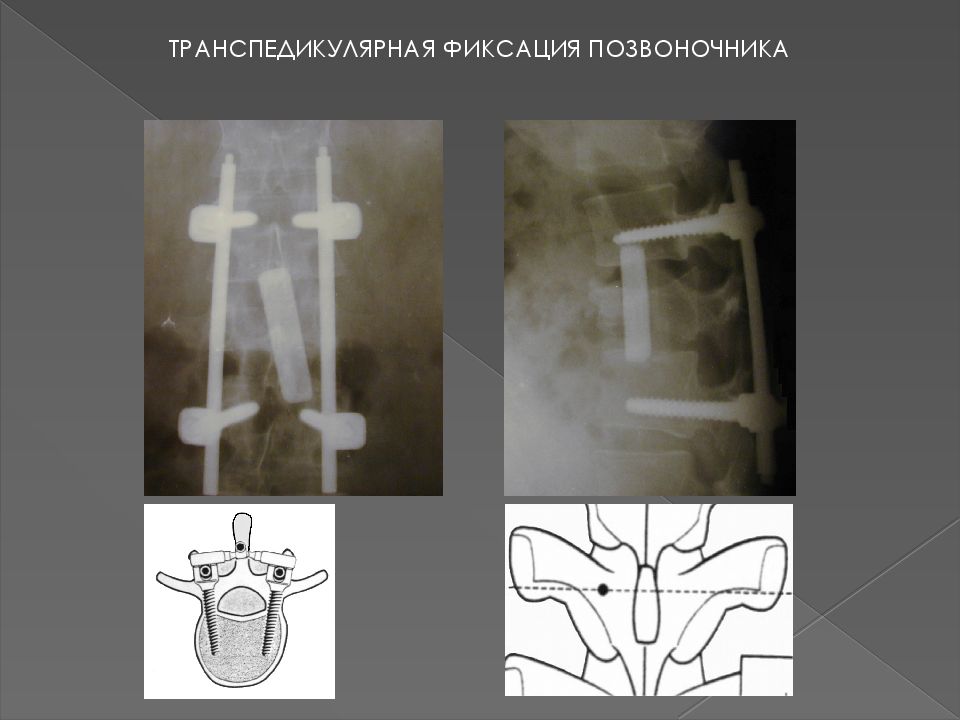 Фиксация позвоночника. Транспедикулярная фиксация позвоночника. Транспедикулярная фиксация кт. Транспедикулярная фиксация 12 позвонка. Схема транспедикулярной фиксации позвоночника.