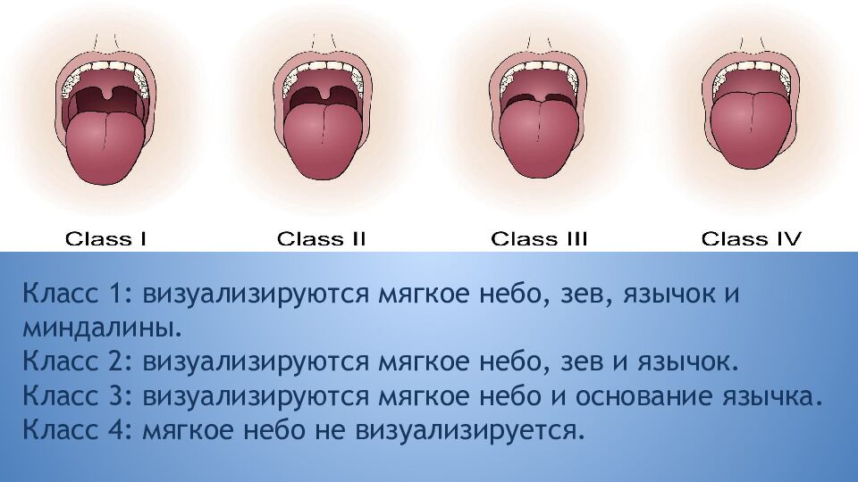 Трудные дыхательные пути в анестезиологической практике. Difficult Airway