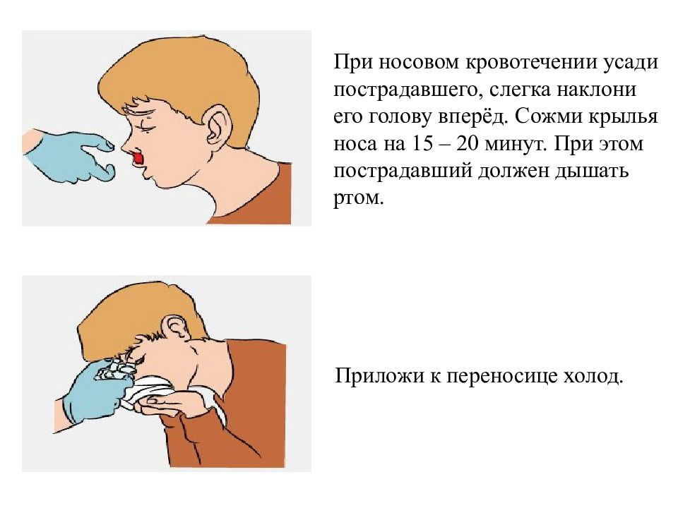 На каком из рисунков наиболее правильно показан метод остановки кровотечения из носа