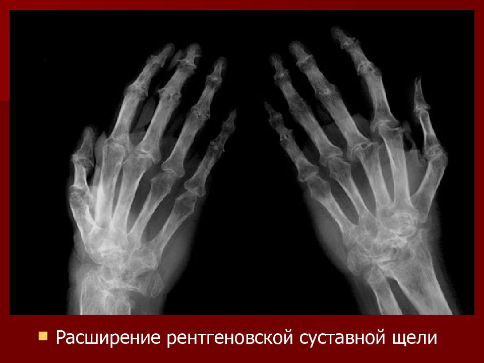 суставная щель коленного сустава рентген. рентгеновская суставная щель. изменение рентгеновской суставной щели. расширение суставной щели на рентгенограмме. остеосклероз тазобедренного сустава.