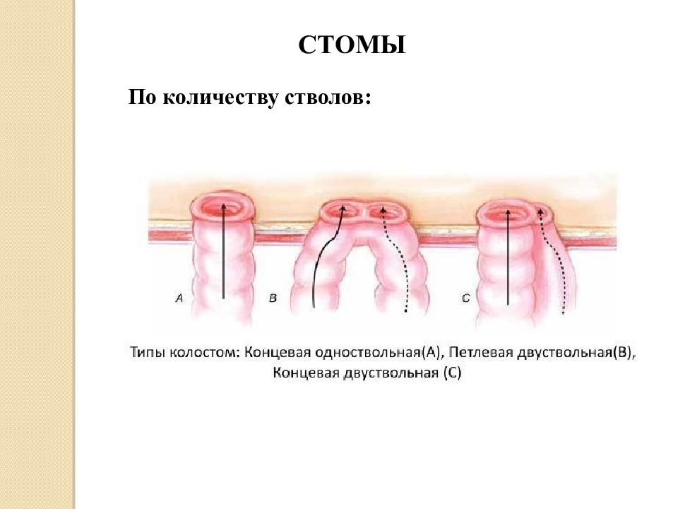 Стома стом. Двуствольная колостома. Одноствольная кишечная Стома. Двуствольная петлевая колостома.