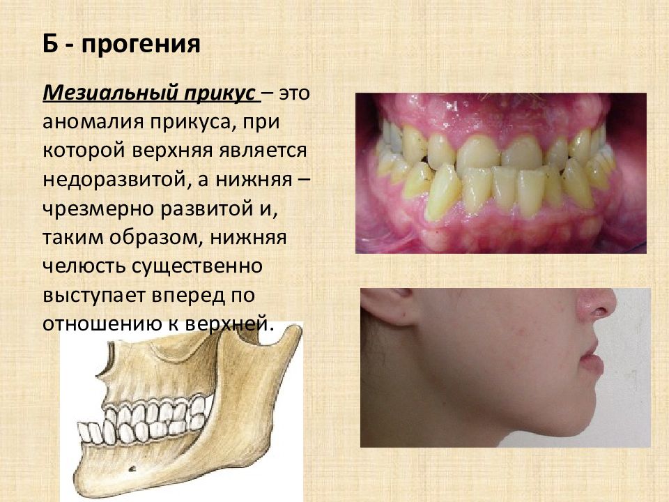 Прогения нижней челюсти. Прогения прогенический прикус. Прикус прогенический мезиальный. Мезиальный прикус челюсть. Патология прикуса прогения.